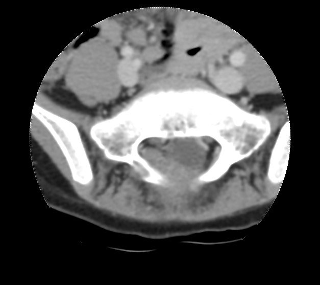 Aneurysmal bone cyst - sacrum (Radiopaedia 65190-74195 Axial non-contrast 17).jpg