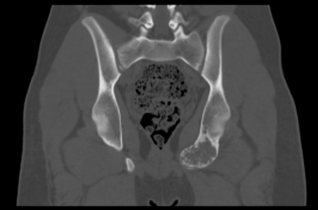 File:Aneurysmal bone cyst of ischium (Radiopaedia 25957-26094 Coronal bone window 27).png