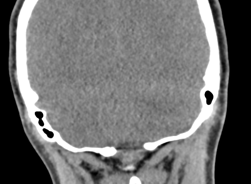 Angular dermoid cyst (Radiopaedia 88967-105790 Coronal non-contrast 101).jpg