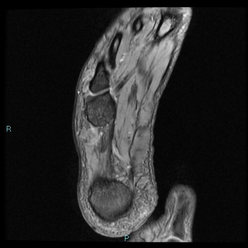 Ankle ganglion cyst (Radiopaedia 62809-71162 Axial Gradient Echo 8).jpg