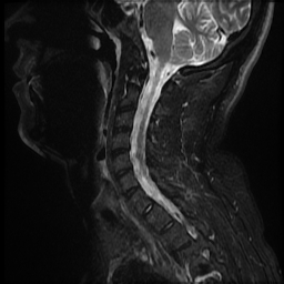 File:Ankylosing spondylitis - shiny corner sign (Radiopaedia 52084-57939 Sagittal T2 18).jpg