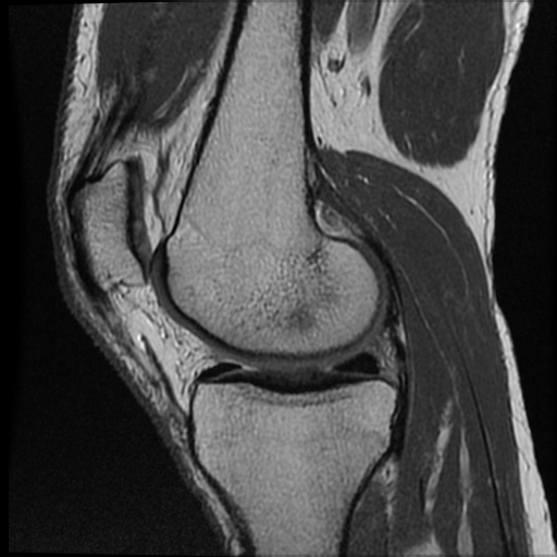 Anomalous insertion of the medial meniscus (Radiopaedia 77559-89721 Sagittal PD 34).jpg