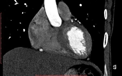 Anomalous left coronary artery from the pulmonary artery (ALCAPA) (Radiopaedia 70148-80181 B 110).jpg