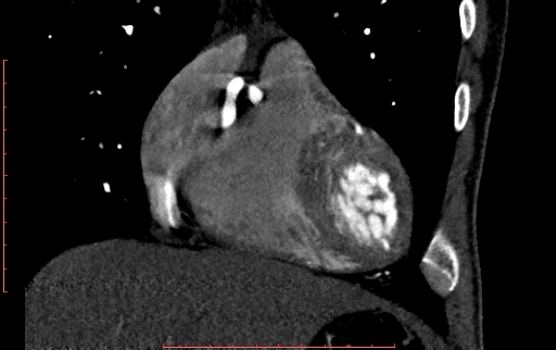 Anomalous left coronary artery from the pulmonary artery (ALCAPA) (Radiopaedia 70148-80181 B 80).jpg