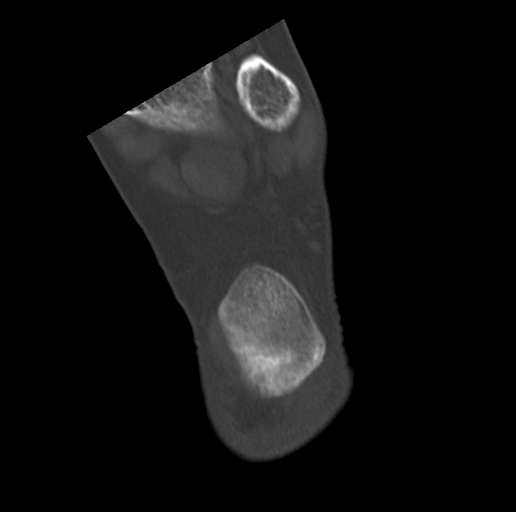 Anterior calcaneal process fracture (Radiopaedia 47384-51989 Coronal bone window 72).png