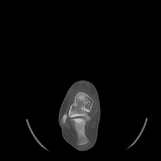 Anterior calcaneal process fracture (Radiopaedia 82590-96762 Axial bone window 17).jpg