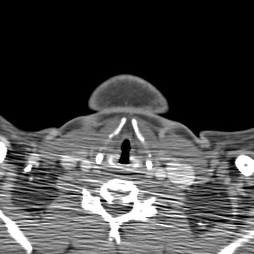 Anterior cerebral artery territory infarct (Radiopaedia 39327-41581 B 85).png