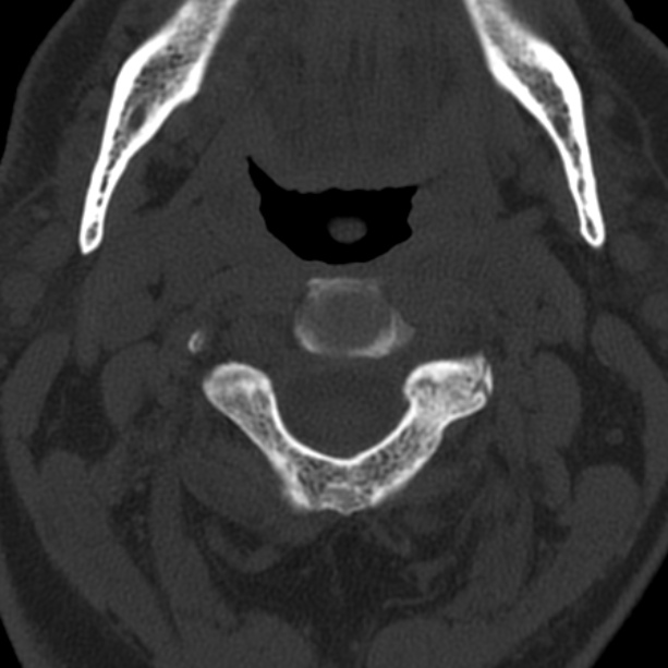 Anterior cervical postdiscectomy arthrodesis (Radiopaedia 32678-33646 Axial bone window 23).jpg
