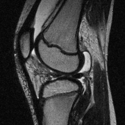 File:Anterior cruciate ligament avulsion fracture (Radiopaedia 24710-24974 Sagittal T2 12).jpg