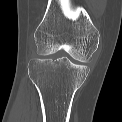 File:Anterior cruciate ligament avulsion fracture (Radiopaedia 58939-66194 Coronal bone window 15).jpg