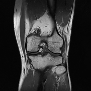 File:Anterior cruciate ligament full thickness tear (Radiopaedia 66268-75467 Coronal T1 13).jpg