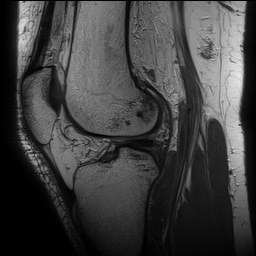 Anterior cruciate ligament rupture with Segond fracture (Radiopaedia 69043-78806 Sagittal PD 108).jpg