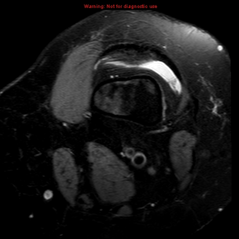 File:Anterior cruciate ligament tear (Radiopaedia 12329-12612 Axial T2 fat sat 21).jpg