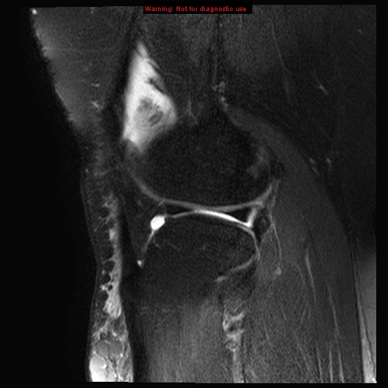 File:Anterior cruciate ligament tear - complete (Radiopaedia 12175-12514 Sagittal T2 fat sat 5).jpg