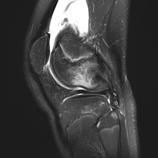 File:Anterior cruciate ligament tear - pediatric (Radiopaedia 62152-70260 Sagittal PD fat sat 28).jpg