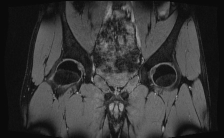 Anterior inferior iliac spine avulsion fracture (Radiopaedia 81312-95000 G 53).jpg