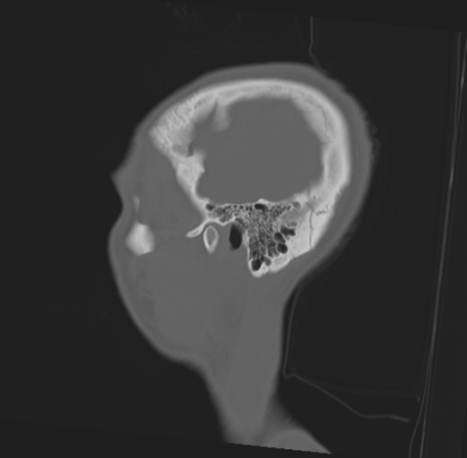 File:Anterior nasal spine fracture (Radiopaedia 46138-50494 Sagittal bone window 10).png