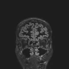 Anterior temporal encephalocele (Radiopaedia 82624-96808 Coronal FLAIR 7).jpg