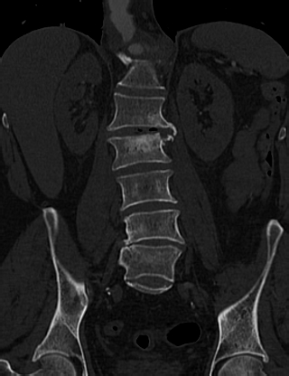 Anterior vertebral scalloping (abdominal aortic aneurysm) (Radiopaedia 66744-76067 Coronal bone window 37).jpg