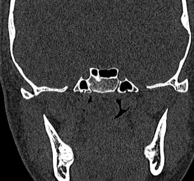 Antrochoanal polyp (Radiopaedia 30002-30554 Coronal bone window 71).jpg