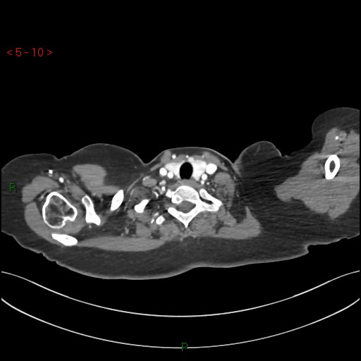 File:Aortic arch origin of left vertebral artery (Radiopaedia 51520-57286 A 9).jpg