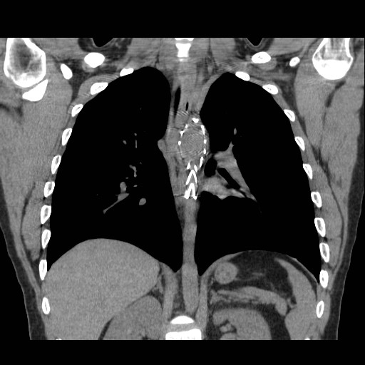 File:Aortic arch stent (Radiopaedia 30030-30595 Coronal non-contrast 17).jpg