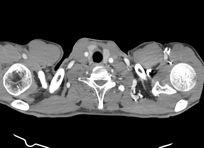 File:Aortic coarctation with aneurysm (Radiopaedia 74818-85828 A 188).jpg