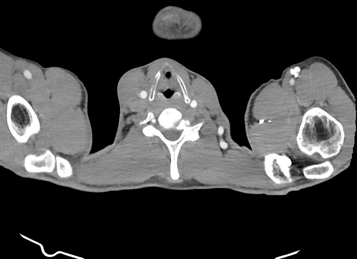 File:Aortic coarctation with aneurysm (Radiopaedia 74818-85828 A 200).jpg