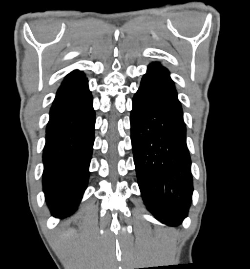 Aortic coarctation with aneurysm (Radiopaedia 74818-85828 C 101).jpg