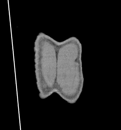 Aortic coarctation with aneurysm (Radiopaedia 74818-85828 C 120).jpg