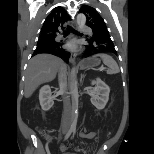 File:Aortic dissection- Stanford A (Radiopaedia 37759-39664 Coronal C+ delayed 28).png