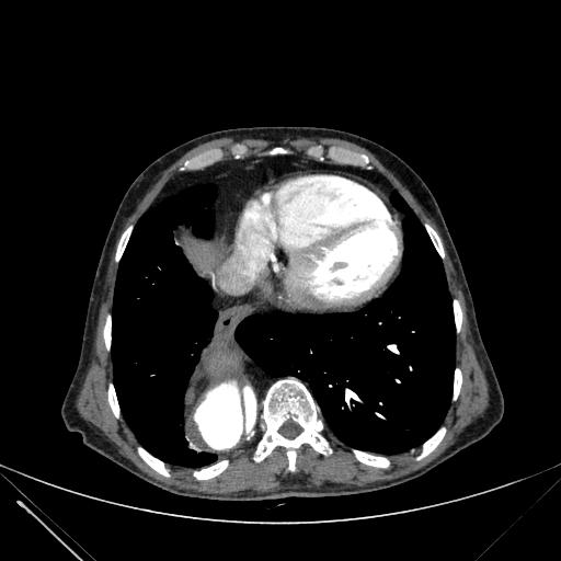 Aortic dissection (Radiopaedia 27466-27665 C+ arterial phase 220).jpg