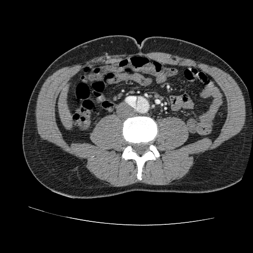 File:Aortic dissection - Stanford A -DeBakey I (Radiopaedia 28339-28587 B 154).jpg