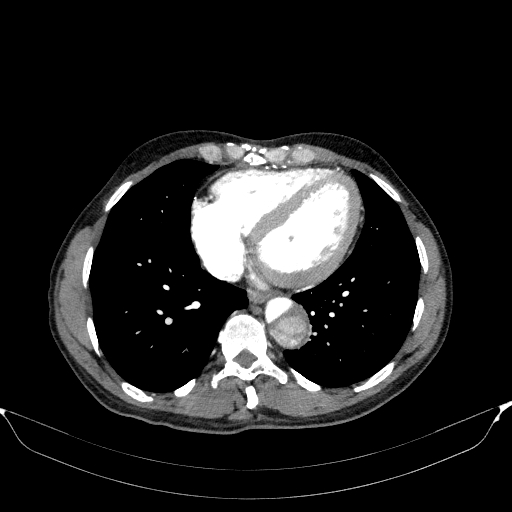 Aortic dissection - Stanford type A (Radiopaedia 83418-98500 A 45).jpg