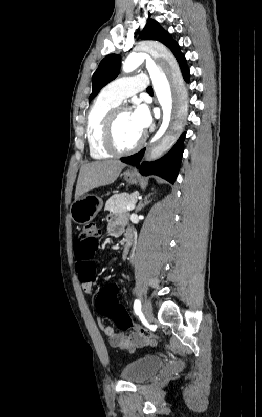 Aortic dissection - Stanford type A (Radiopaedia 83418-98500 B 51).jpg