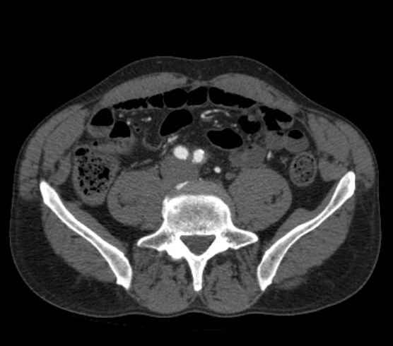 Aortic dissection - Stanford type B (Radiopaedia 73648-84437 A 200).jpg