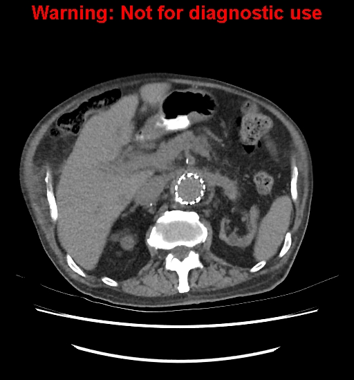 Aortic graft infection (Radiopaedia 44979-48907 Axial non-contrast 38).jpg