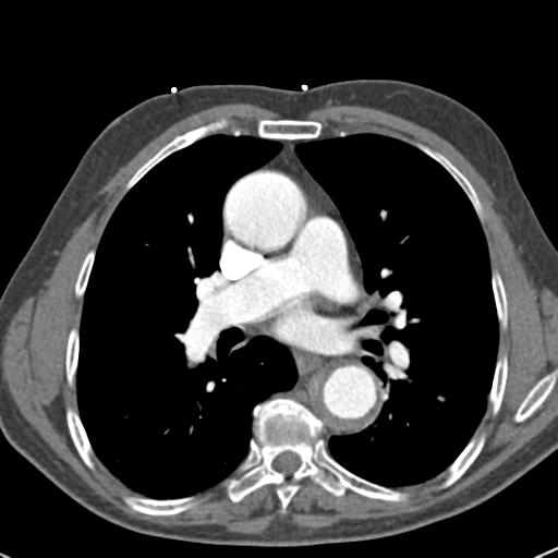 Aortic intramural hematoma (Radiopaedia 31139-31838 B 44).jpg