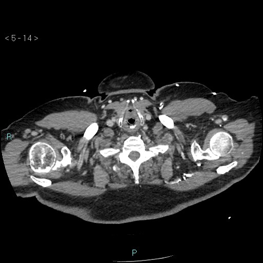 Aortic intramural hematoma (Radiopaedia 48463-53380 C 8).jpg