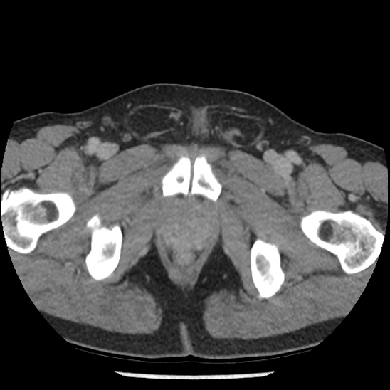 File:Aortic intramural hematoma (type B) (Radiopaedia 79323-92387 Axial C+ delayed 117).jpg