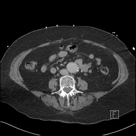 Aortic intramural hematoma with dissection and intramural blood pool (Radiopaedia 77373-89491 E 47).jpg