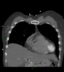 File:Aortic valve endocarditis (Radiopaedia 87209-103485 D 53).jpg