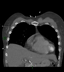 Aortic valve endocarditis (Radiopaedia 87209-103485 D 54).jpg
