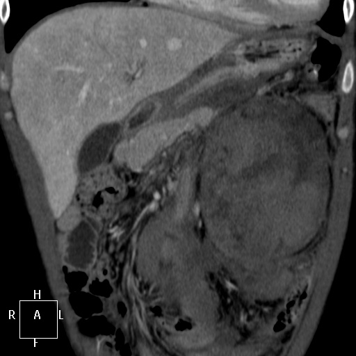 Aorto-left renal vein fistula (Radiopaedia 45534-49628 B 10).jpg