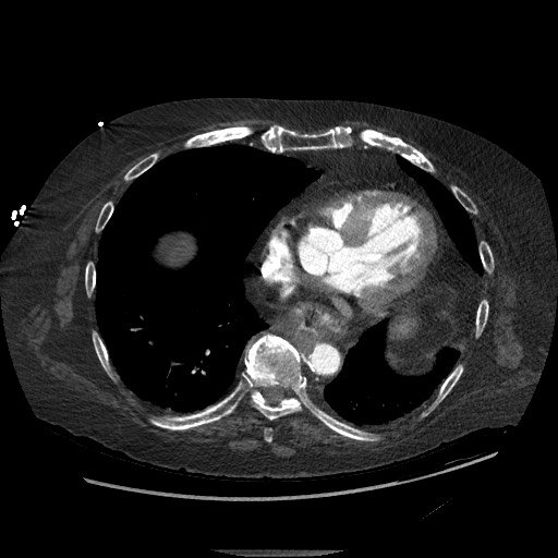 Aortoesophageal fistula with endovascular repair (Radiopaedia 73781-84592 Axial C+ CTPA 111).jpg