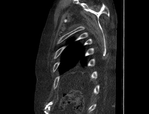 Aortoesophageal fistula with endovascular repair (Radiopaedia 73781-84592 Sagittal C+ CTPA 180).jpg