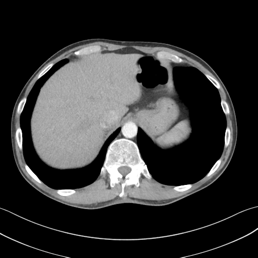 File:Apical pleural calcification (Radiopaedia 46141-50499 Axial C+ delayed 62).png