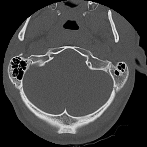 File:Apical pneumothorax on cervical spine CT (Radiopaedia 45343-49368 Axial bone window 4).jpg
