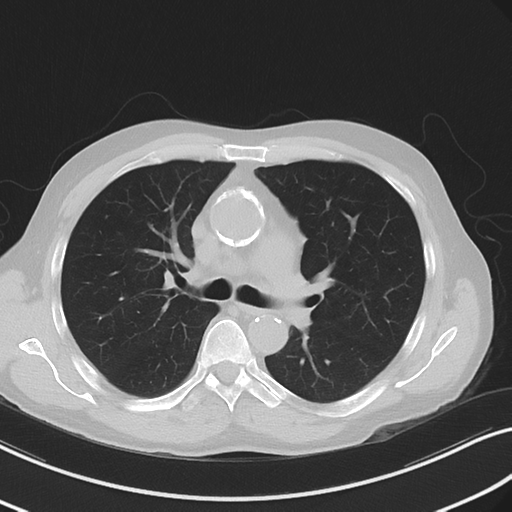 Apical pulmonary metastasis (Radiopaedia 46338-50754 Axial non-contrast 28).png