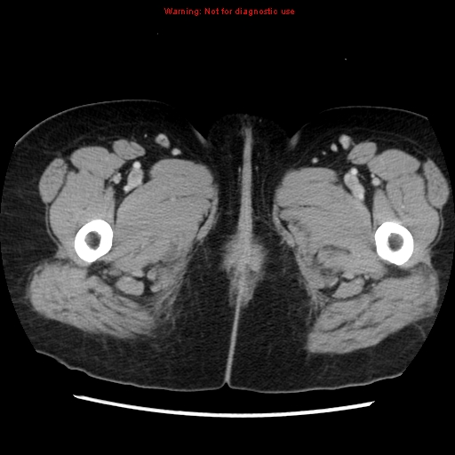 File:Appendiceal mucinous cystadenoma (Radiopaedia 8263-9111 Axial liver window 90).jpg
